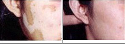 Monobenzone powder effectively fades dark spots Monobenzone powder effectively fades dark spots
